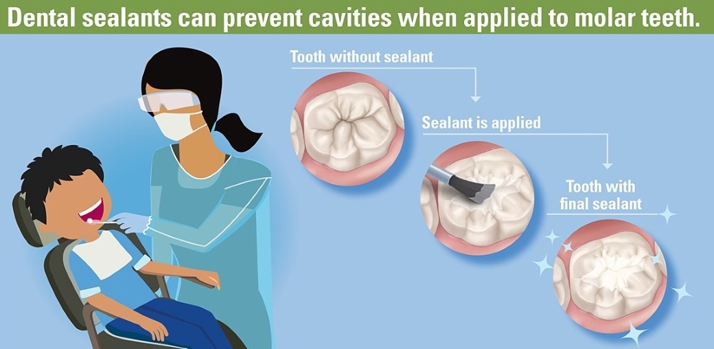 Benefits of Dental Sealants for Children