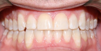 Invisalign_Adult-after