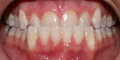 Invisalign_Adult-before