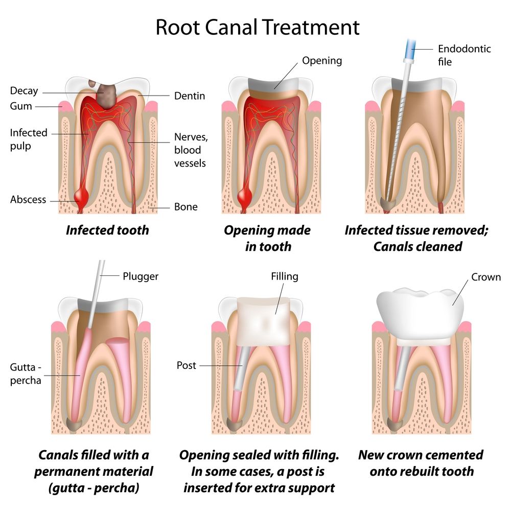 Root Canal Therapy