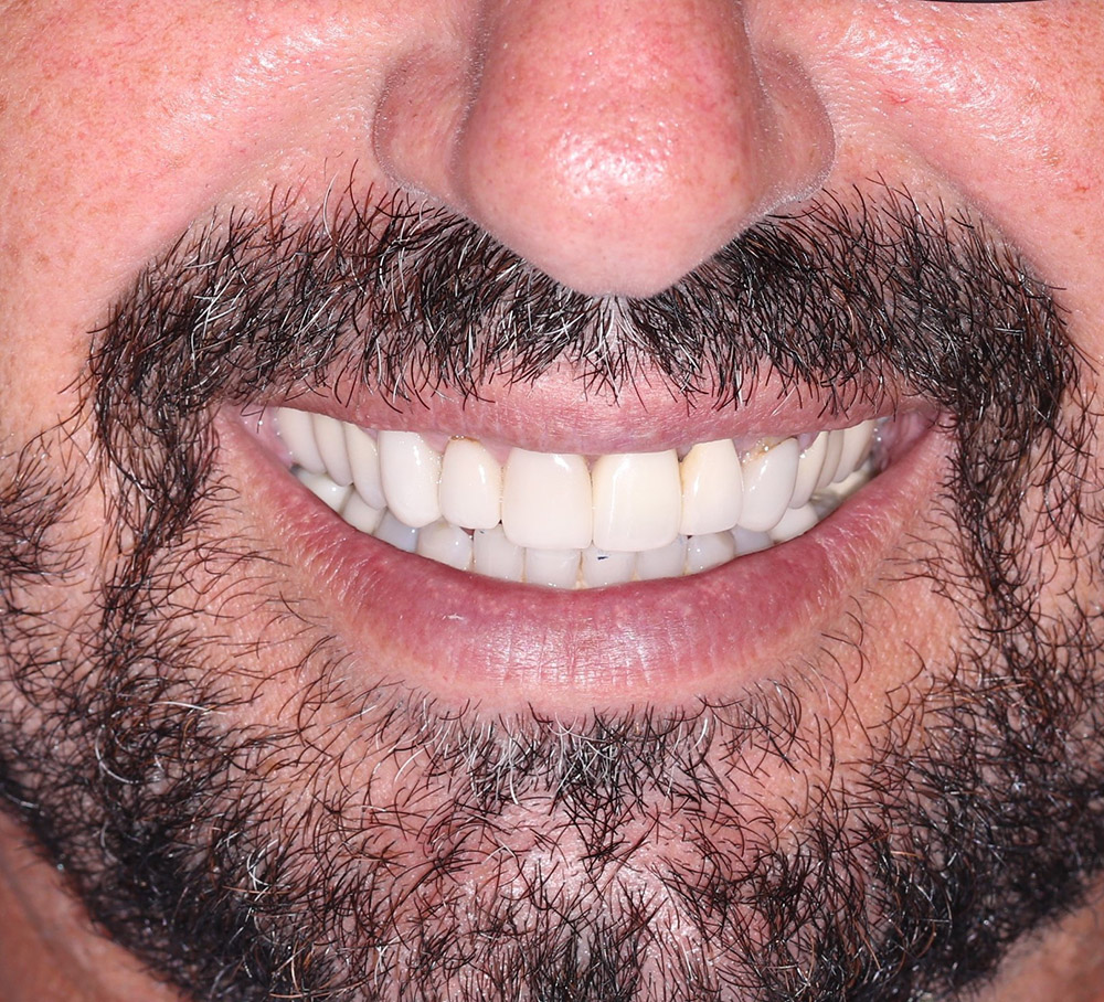 dental implants after