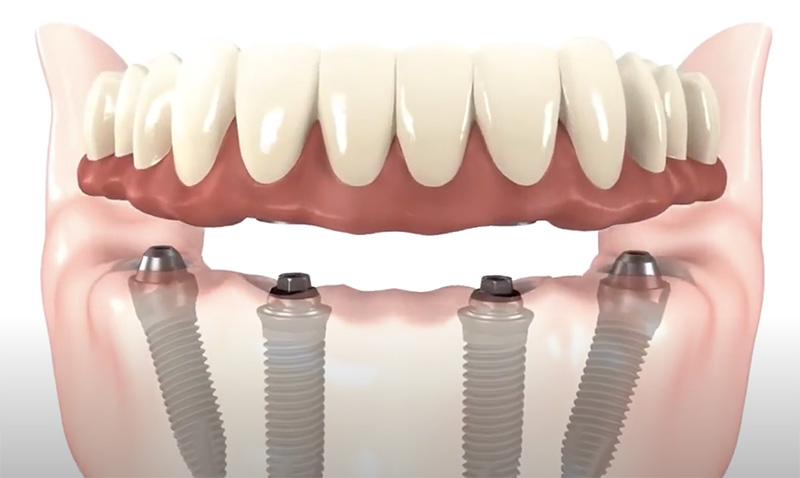 dental implants