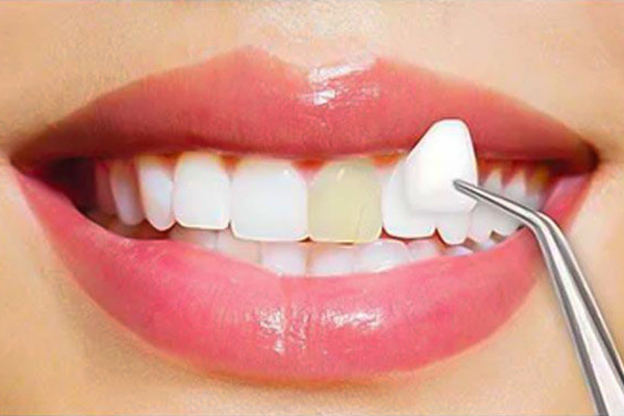 porcelain veneers