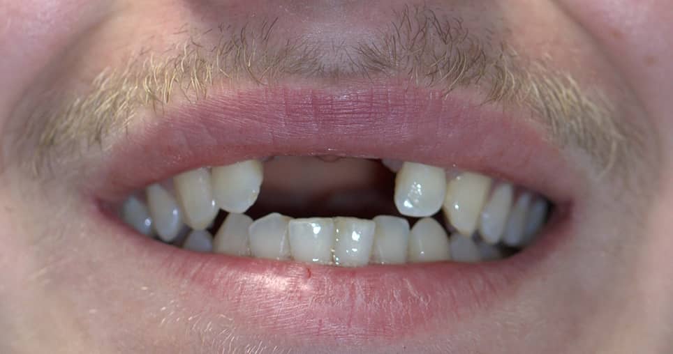 dental implants before