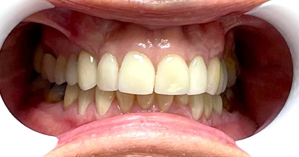 dental implants before