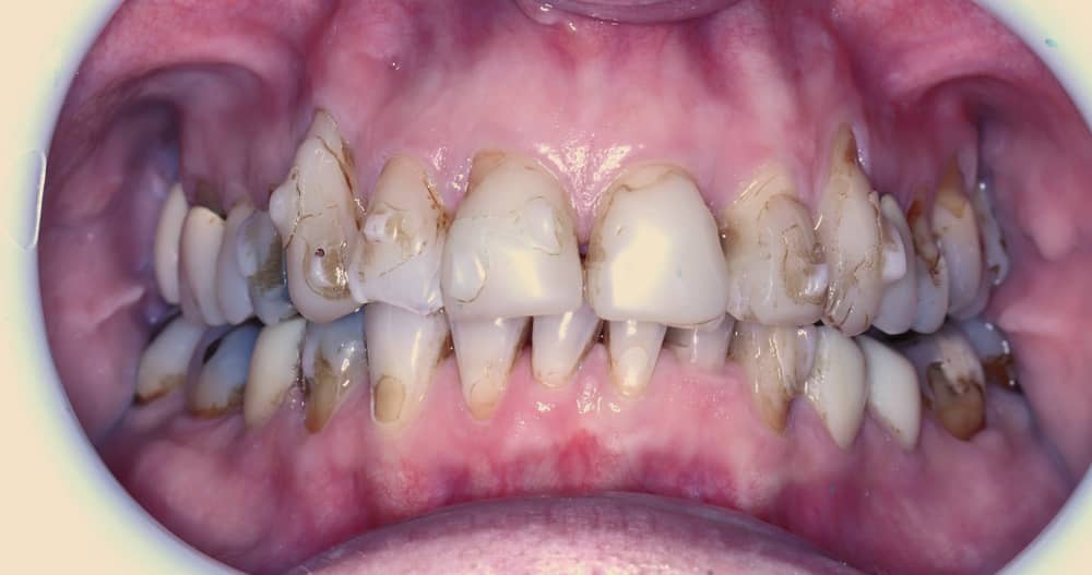 dental implants before