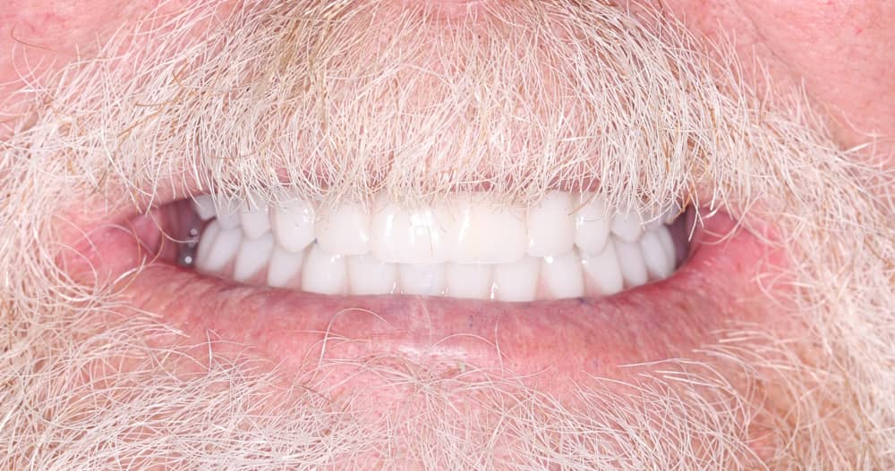 dental implants before
