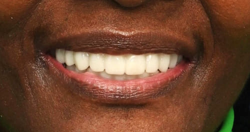 dental implants before