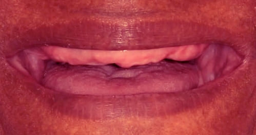 dental implants before