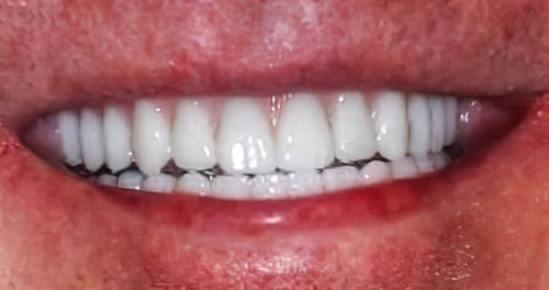 dental implants before