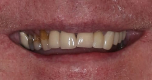 dental implants before