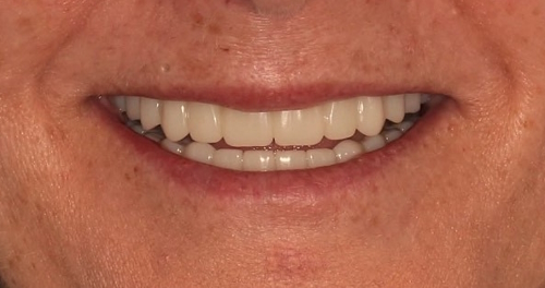 dental implants before