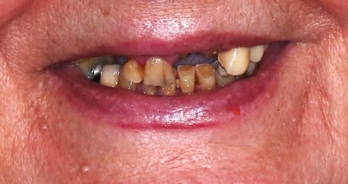 dental implants before