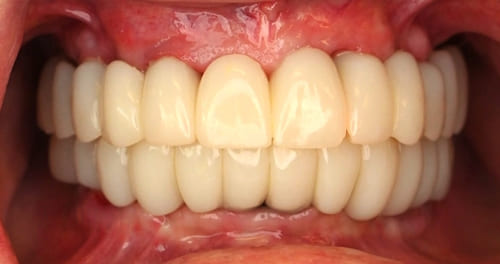 dental implants before