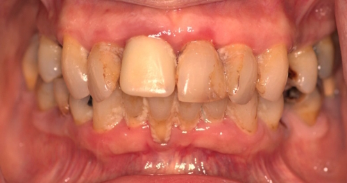 dental implants before